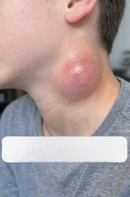 Understanding Sudden Neck Lumps in Children: What Parents Should Know